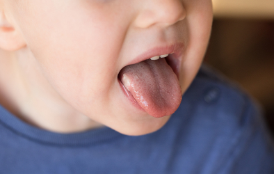 Oral Thrush (Fungal infection in the mouth)