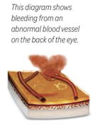 bleeding from  an abnormal blood vessel