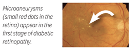 diabetic retinopathy stage1
