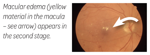 diabetic retinopathy stage2