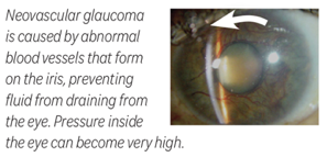 neovascular glaucoma