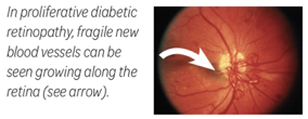 proliferative diabetic retinopathy