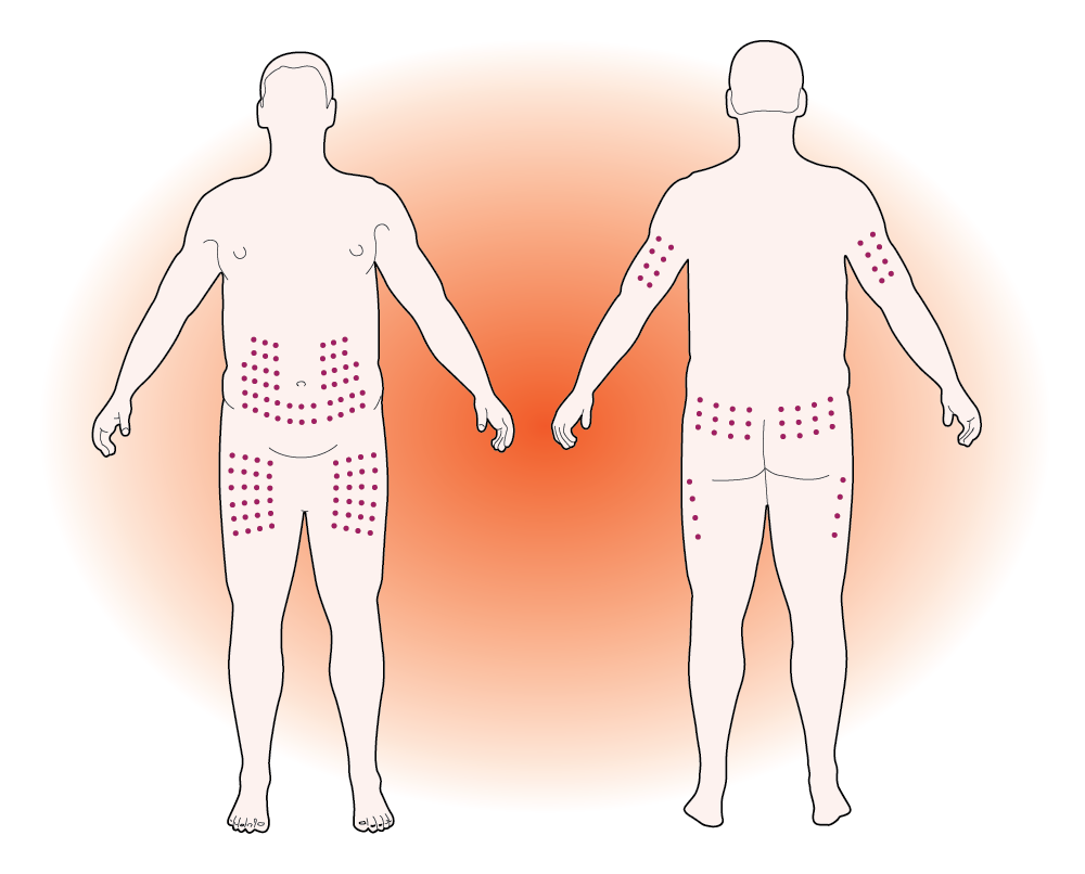 recommended injection sites